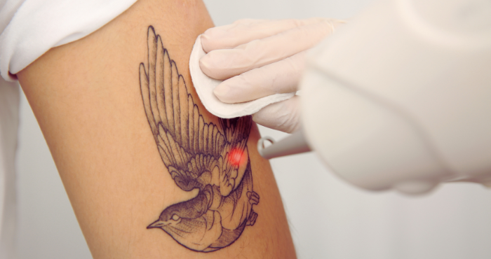 Tattoo removal with PicoSure laser: Effective, safe, and advanced
