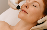 Microneedling Glow Therapy